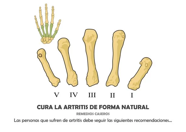 Imagen; Cura la artritis de forma natural; Akashicos